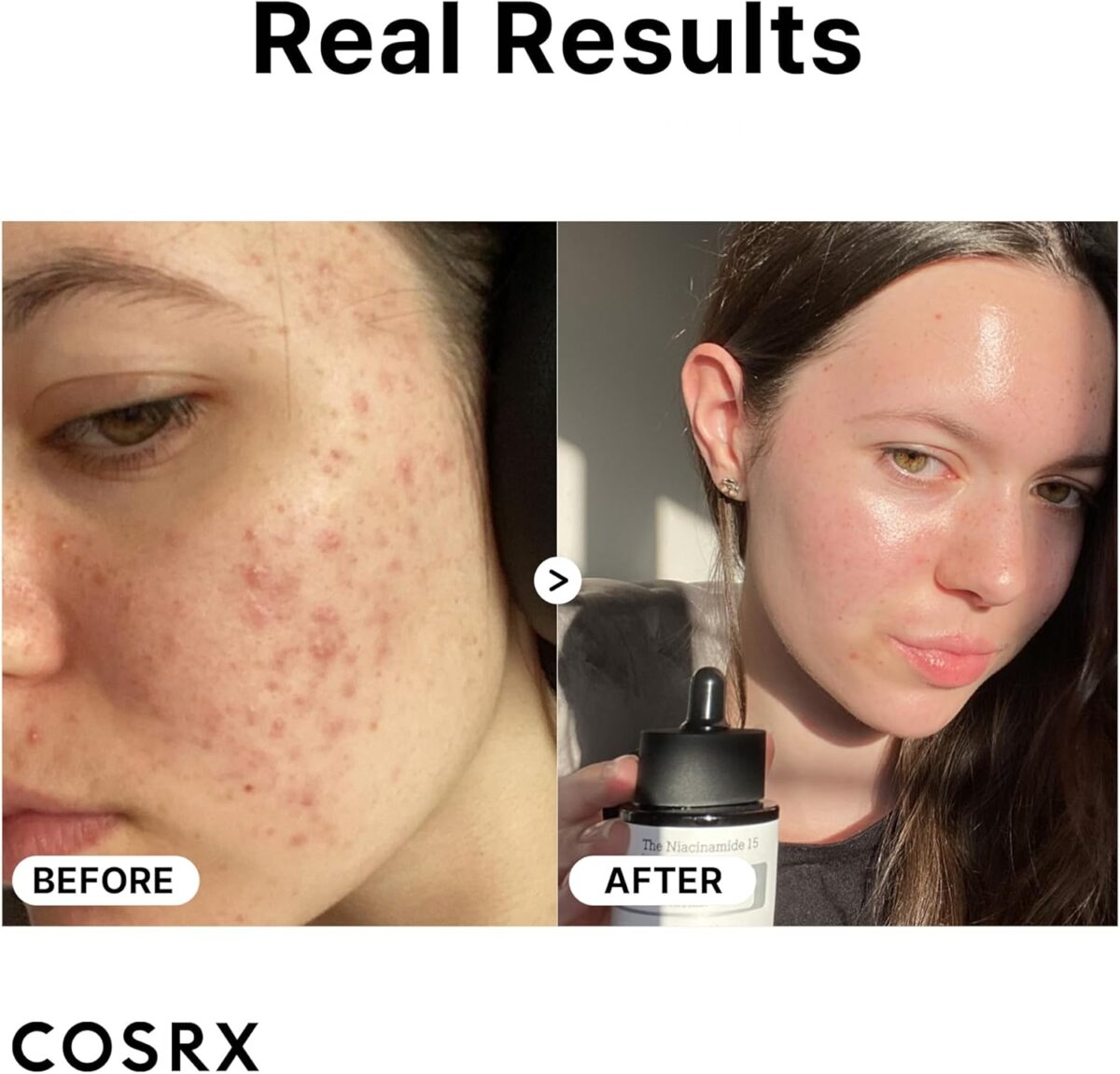 Prima e Dopo - Risultati - COSRX Niacinamide 15% Face Serum COSRX - Niacinamide 15% Face Serum - immagine 4