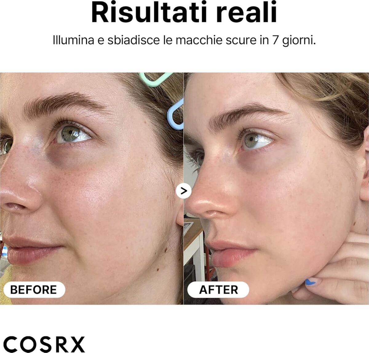 Risultati - Prima e Dopo - COSRX Siero di vitamina C pura al 23% - Vitamina E - Acido Ialuronico, 20 g COSRX - The Vitamin C 23 Serum 20g – Siero viso - immagine 7