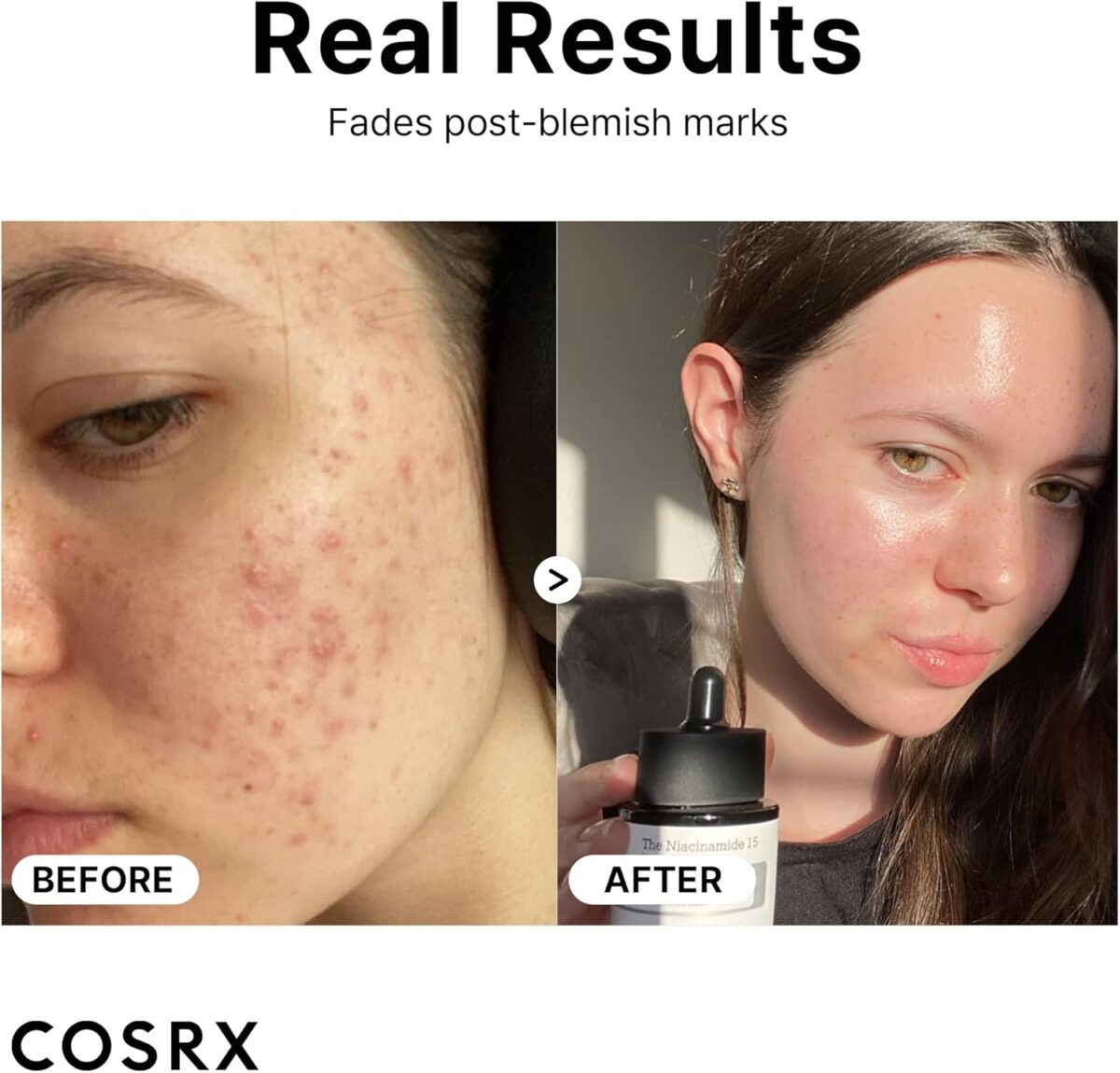 risultati Prima e Dopo - COSRX -The Niacinamide 15 Serum COSRX – The Niacinamide 15 Serum, 20ml - immagine 8